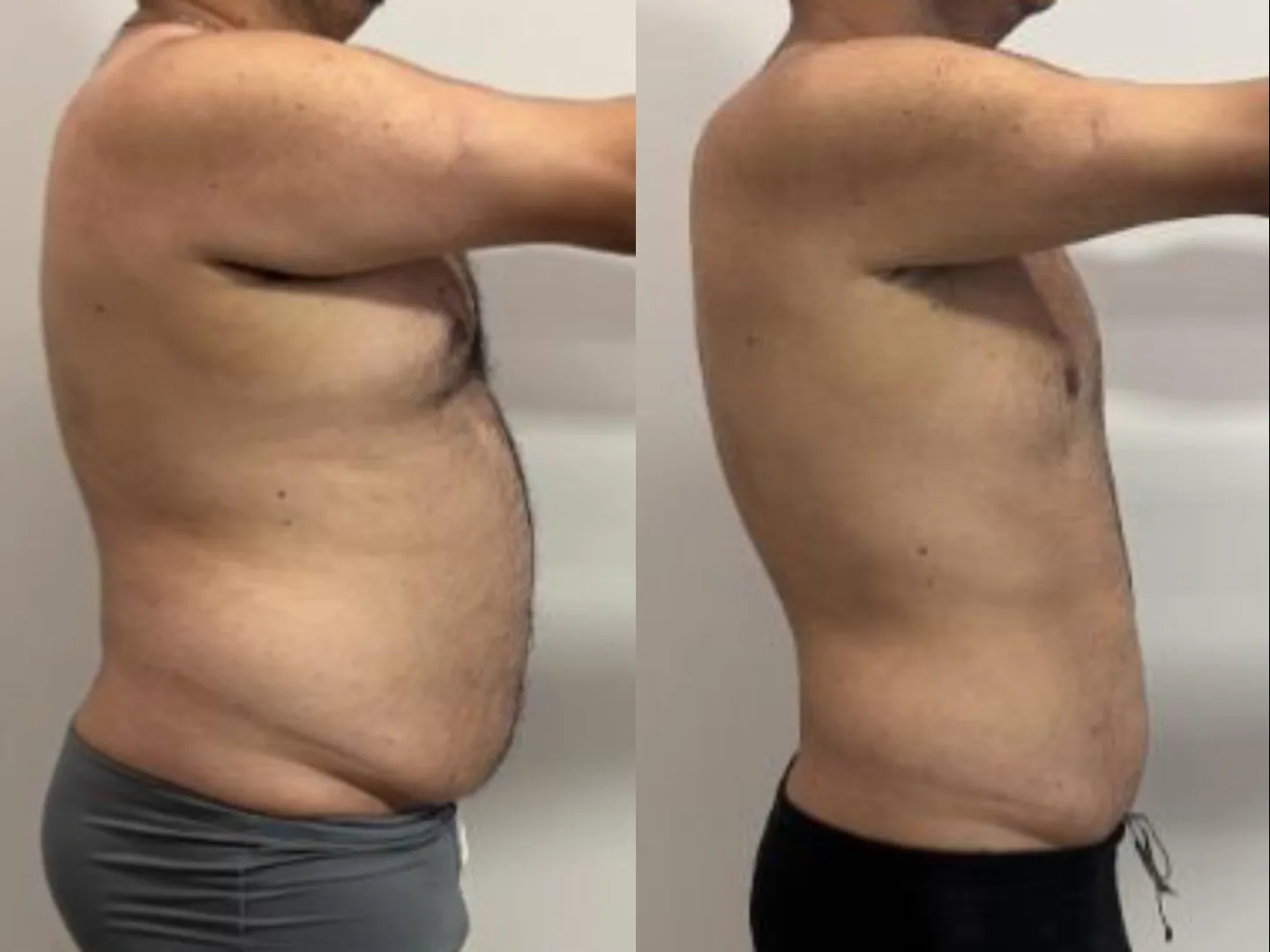 Resultado de emagrecimento e hipertrofia com o acompanhamento ELO — antes e depois 2